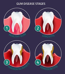 Gum Disease Treatment | Dentist in Scottsdale, AZ | Zuch Periodontics & Dental Implants