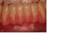 Gum Grafting Dentist in Scottsdale, AZ | Zuch Periodontics & Dental Implants